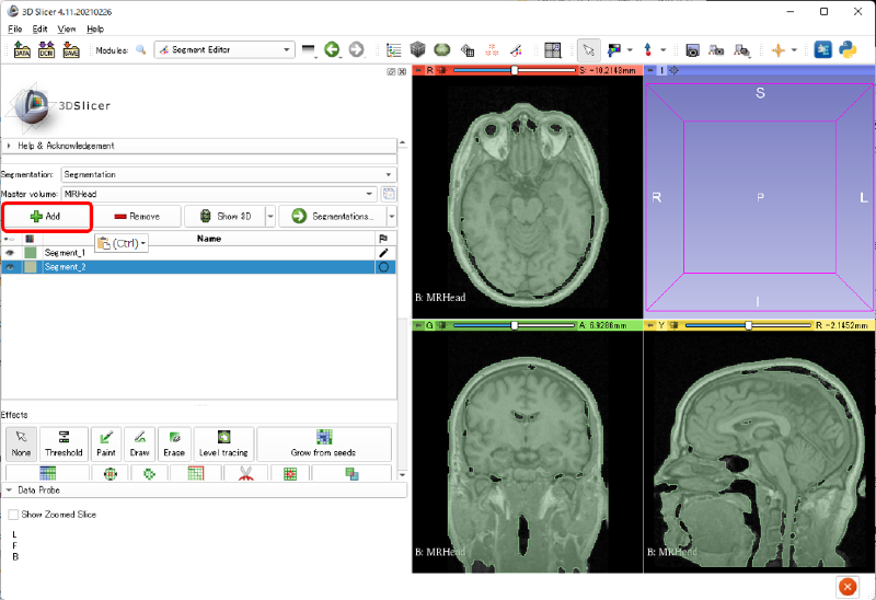 病巣を模擬するSegmentの追加