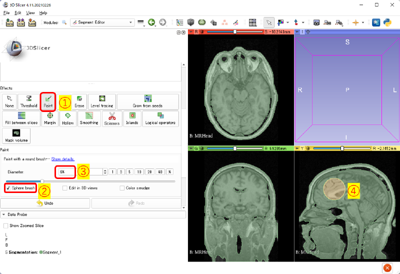 病巣を模擬するセグメンテーション